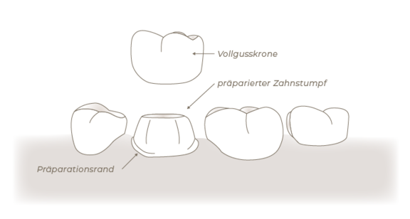 Grafik Zahnkrone, Zahnarzt Frankfurt, Zahnärztin Dr. Thormeyer, dental island
